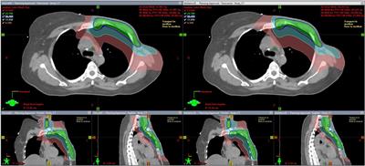 Can knowledge based treatment planning of VMAT for post-mastectomy locoregional radiotherapy involving internal mammary chain and supraclavicular fossa improve performance efficiency?